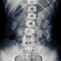 Night Skinny - Mattoni X-Ray vinyl cover